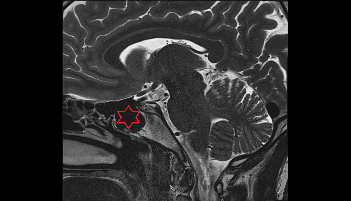 MRI Sphenoidal sinus  anatomy image -img-00000-00000