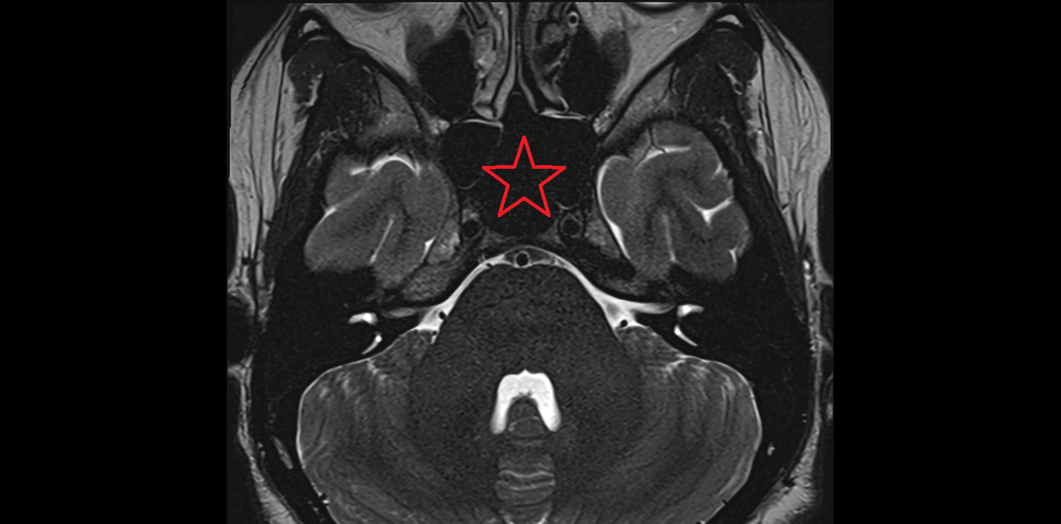 MRI Sphenoidal sinus  anatomy image -img-00000-00000_00001