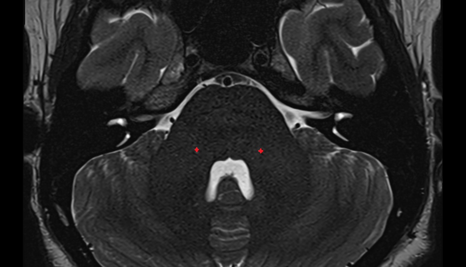 MRI Spinal lemniscus axial anatomy image -img-00000-00000