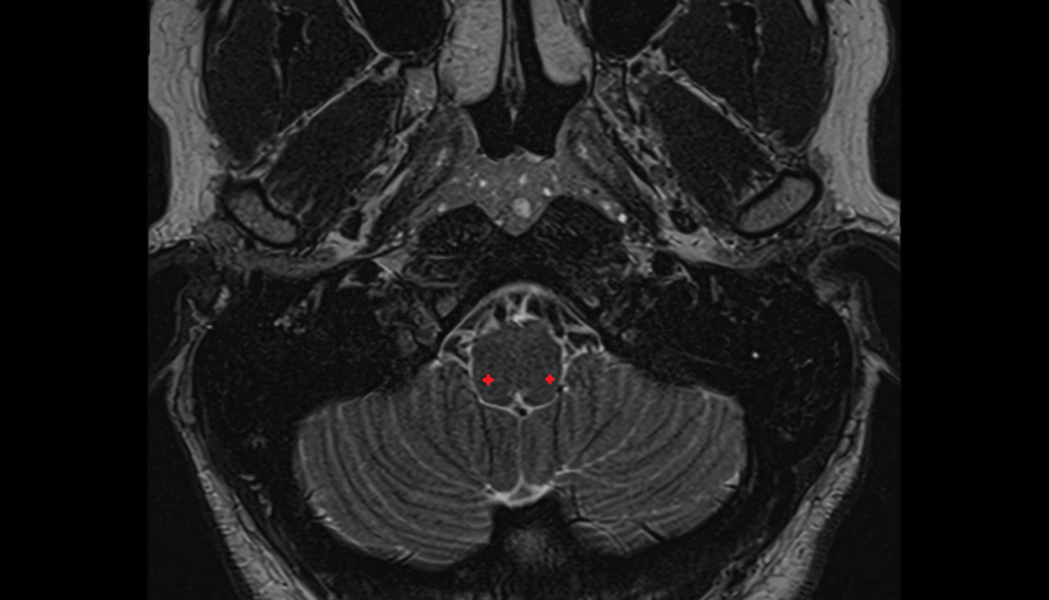 MRI Spinal trigeminal nucleus (pars caudalis)  sag anatomy image -img-00000-00000