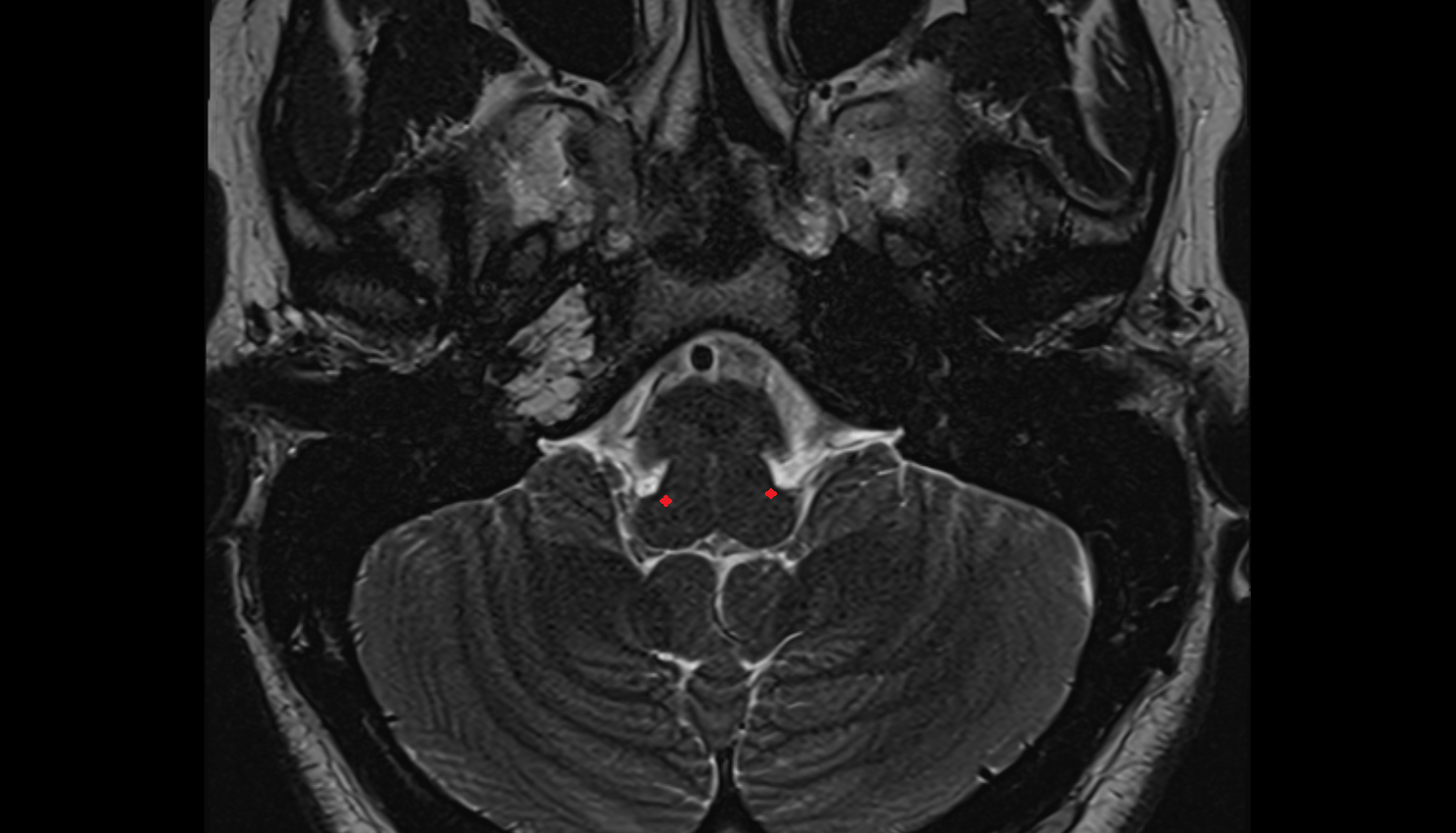 MRI Spinal trigeminal nucleus (pars oralis)  axial anatomy image -img-00000-00000