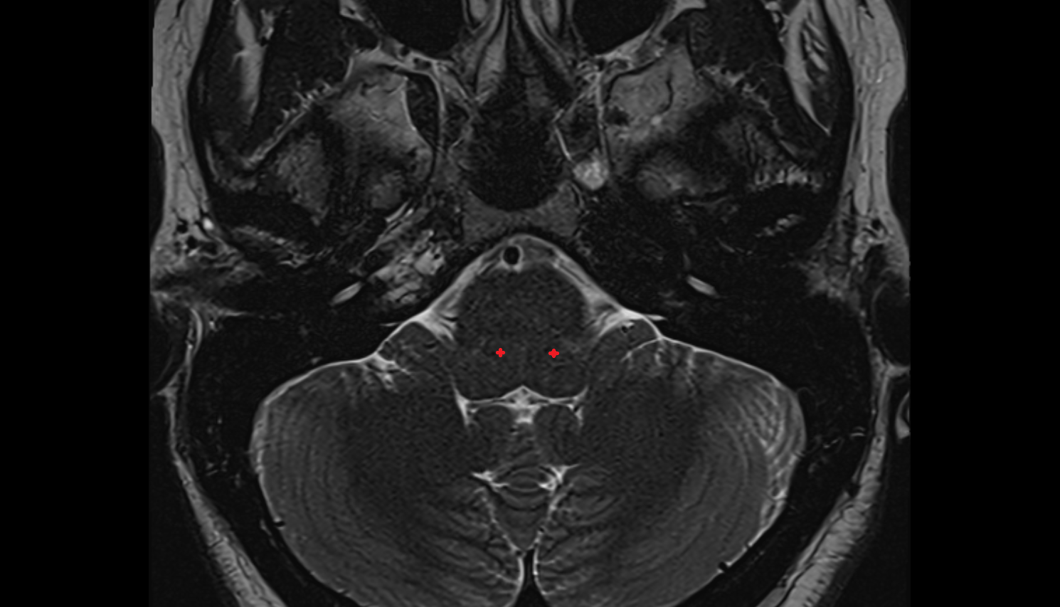 MRI Spinal trigeminal nucleus (pars oralis)  axial anatomy image -img-00000-00000_00001