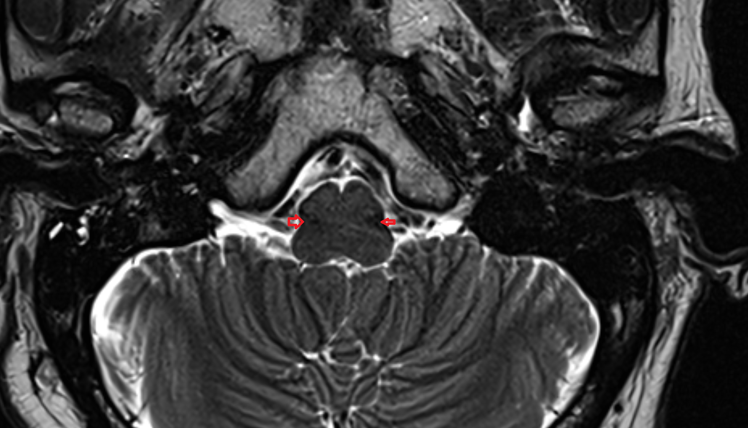 MRI Spinothalamic tract axial anatomy image -img-00000-00000