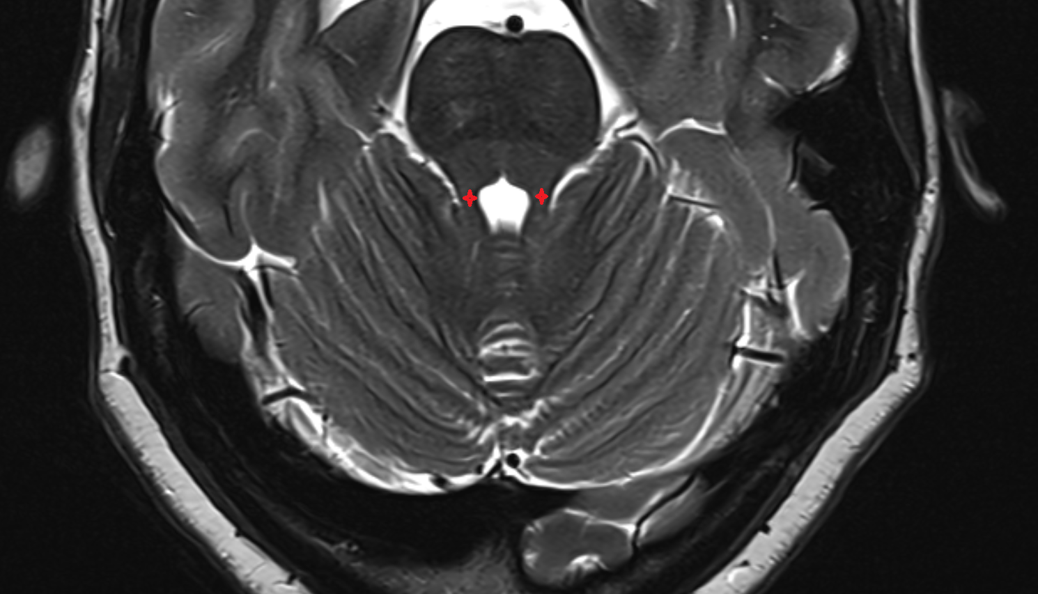 MRI Superior cerebellar peduncle axial anatomy image -img-00000-00000