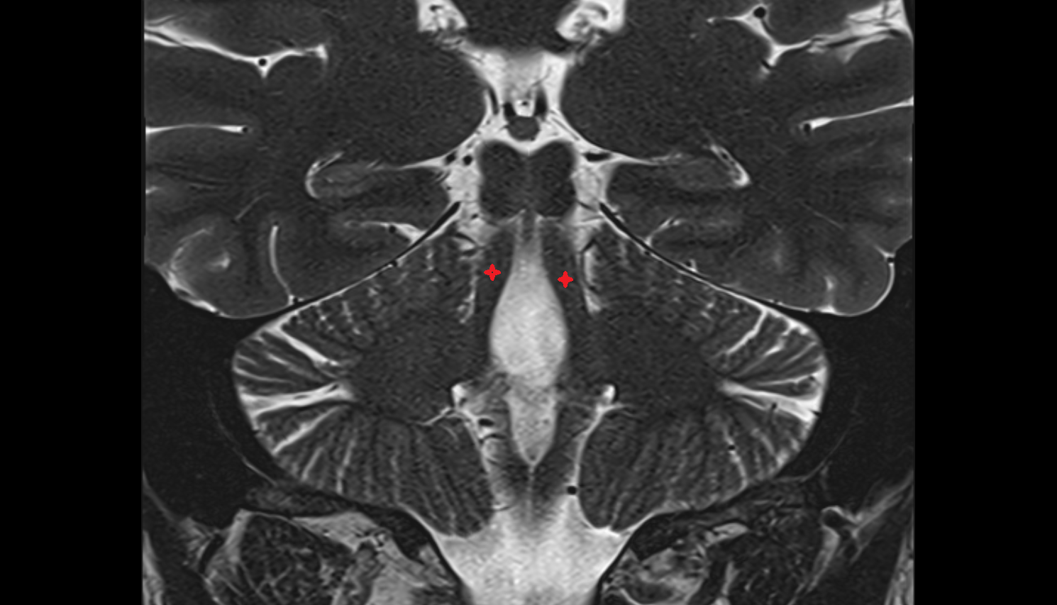 MRI Superior cerebellar peduncle coronal anatomy image -img-00000-00000