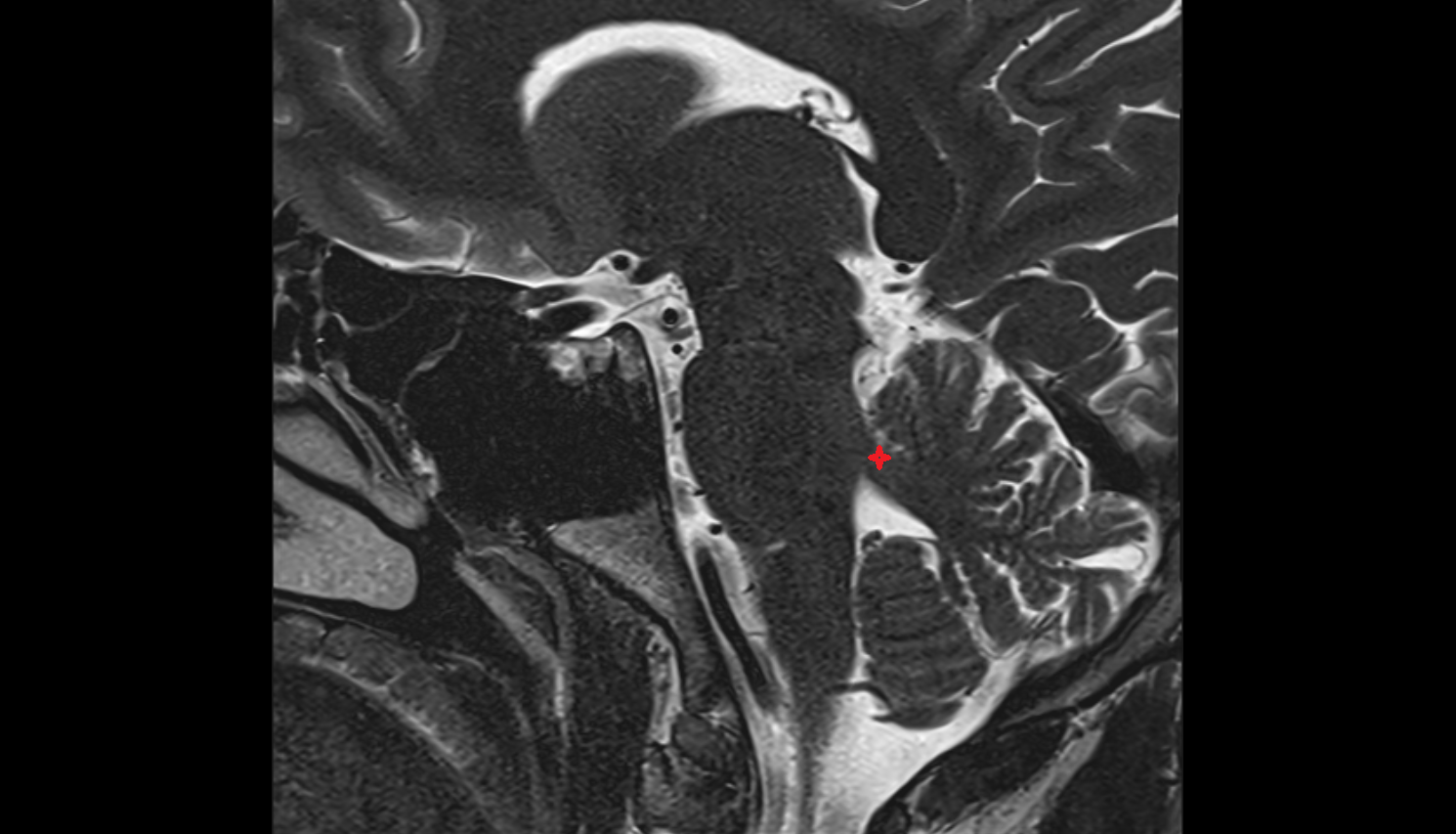 MRI Superior cerebellar peduncle sag anatomy image -img-00000-00000