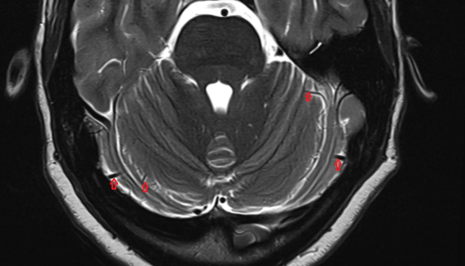 MRI Superior hemispheric cerebellar veins axial anatomy image -img-00000-00000