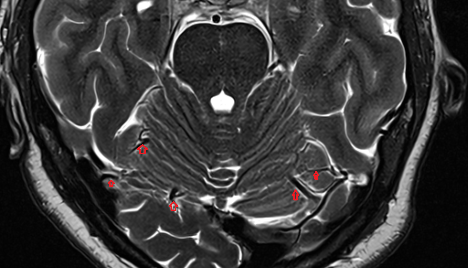 MRI Superior hemispheric cerebellar veins axial anatomy image -img-00000-00000_00001