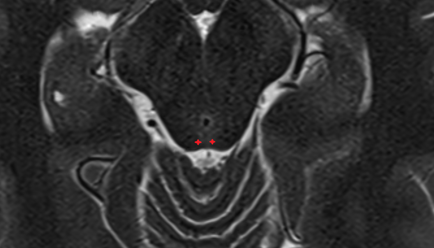 MRITectal plate (quadrigeminal plate) anatomy image -img-00000-00000
