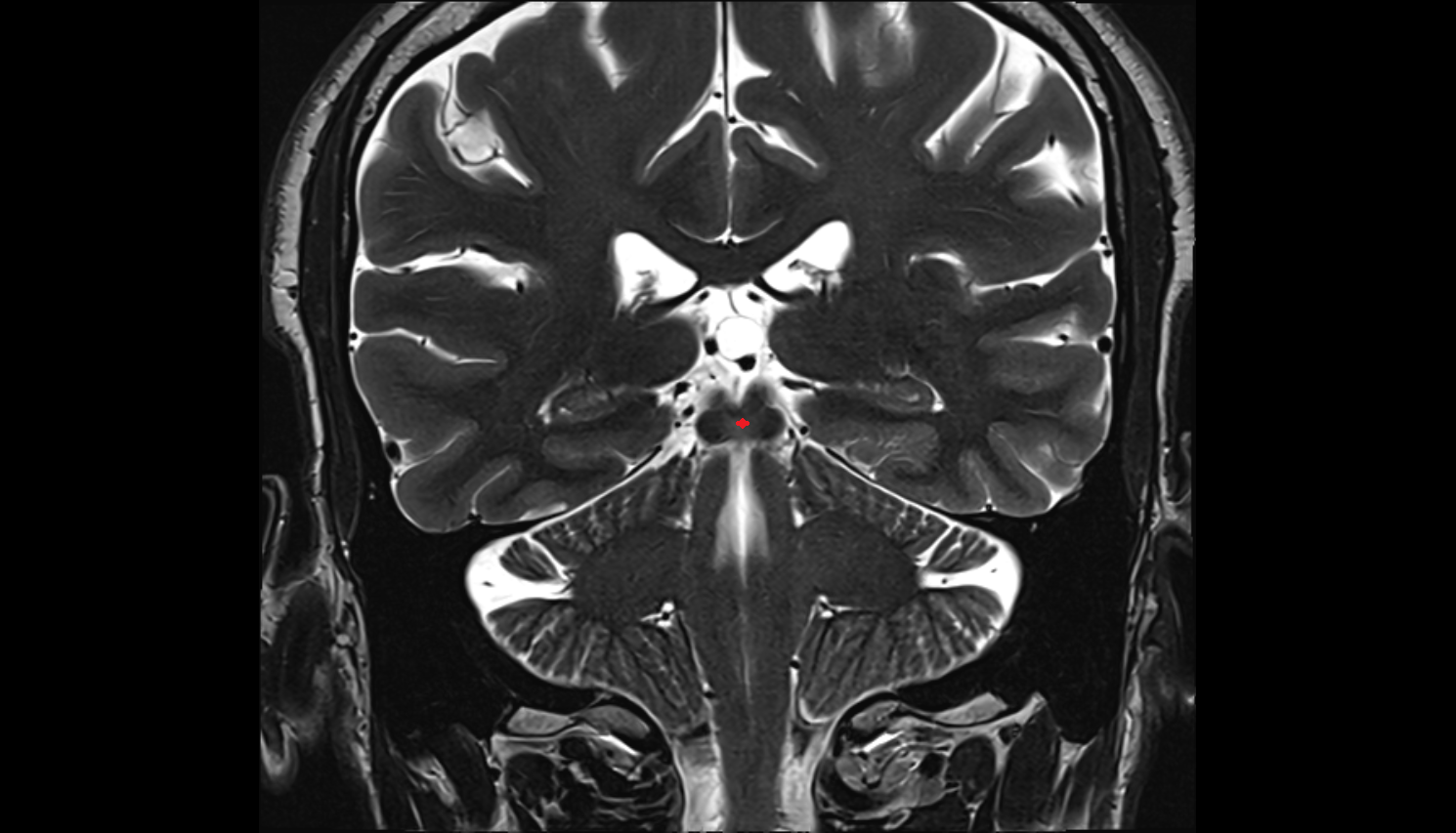 MRITectal plate (quadrigeminal plate) anatomy image -img-00000-00000_00001