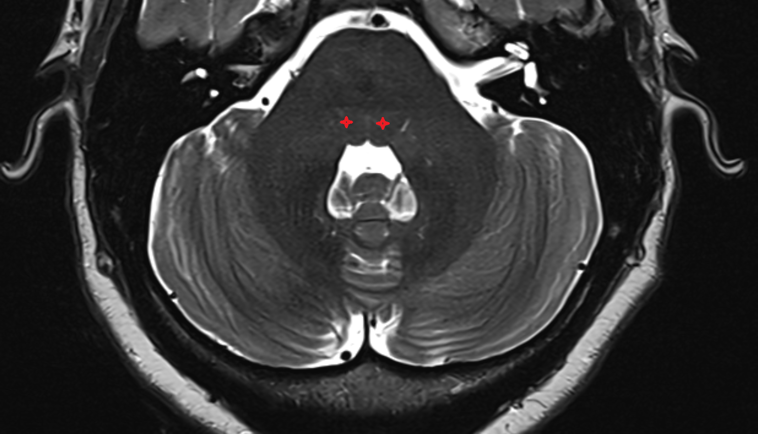 MRI Tegmentum of pons axi anatomy image -img-00000-00000