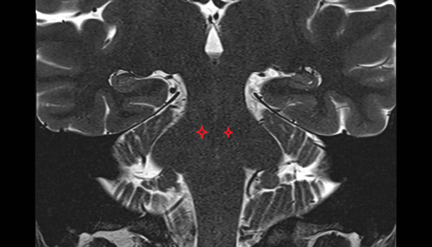 MRI Tegmentum of pons coronal anatomy image -img-00000-00000