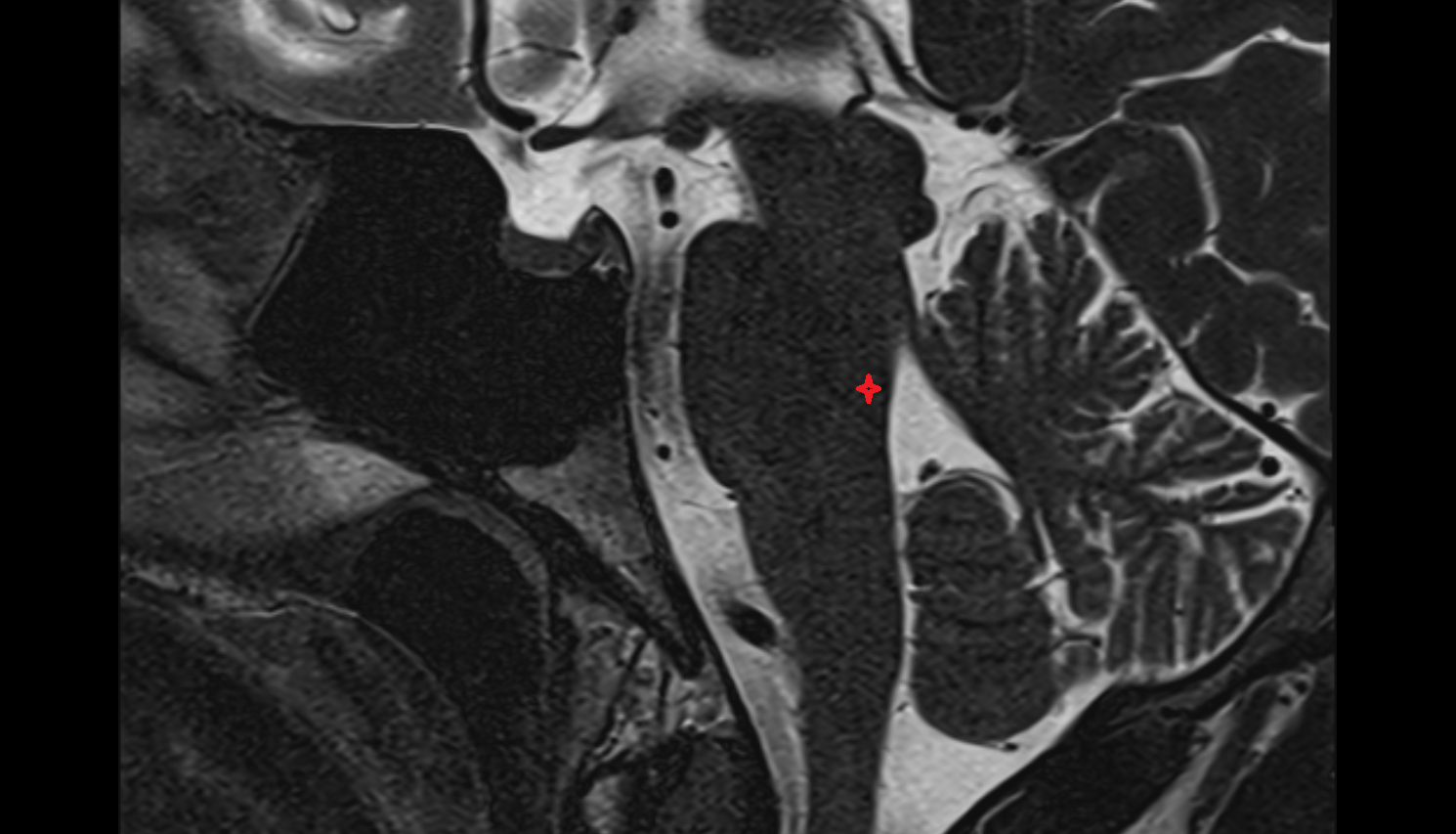 MRI Tegmentum of pons sag anatomy image -img-00000-00000