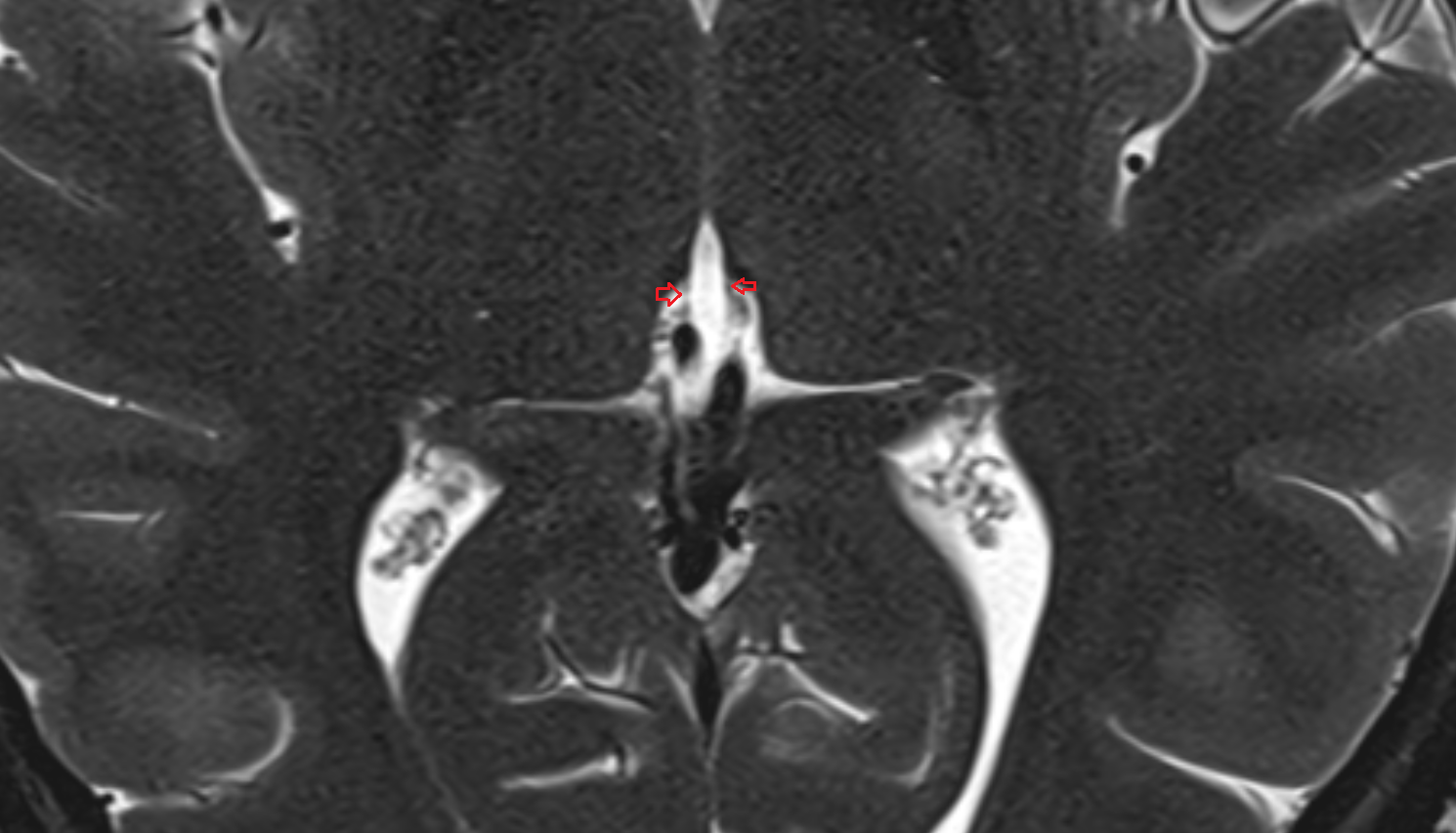 MRI Tela choroidea of third ventricle anatomy image -img-00000-00000