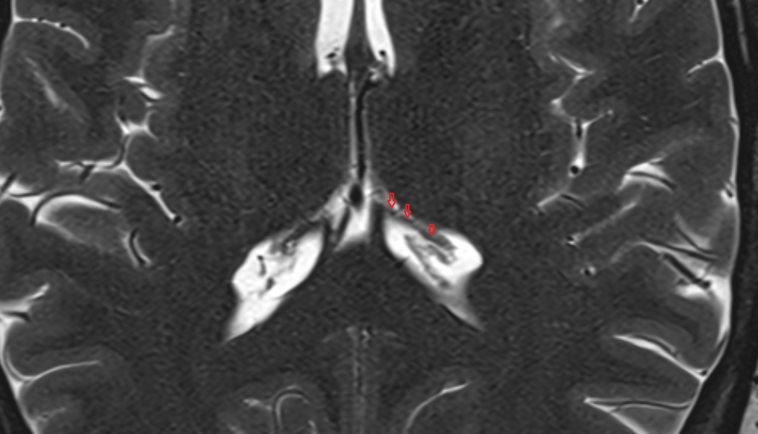 MRI Tenia of fornix anatomy image -img-00000-00000