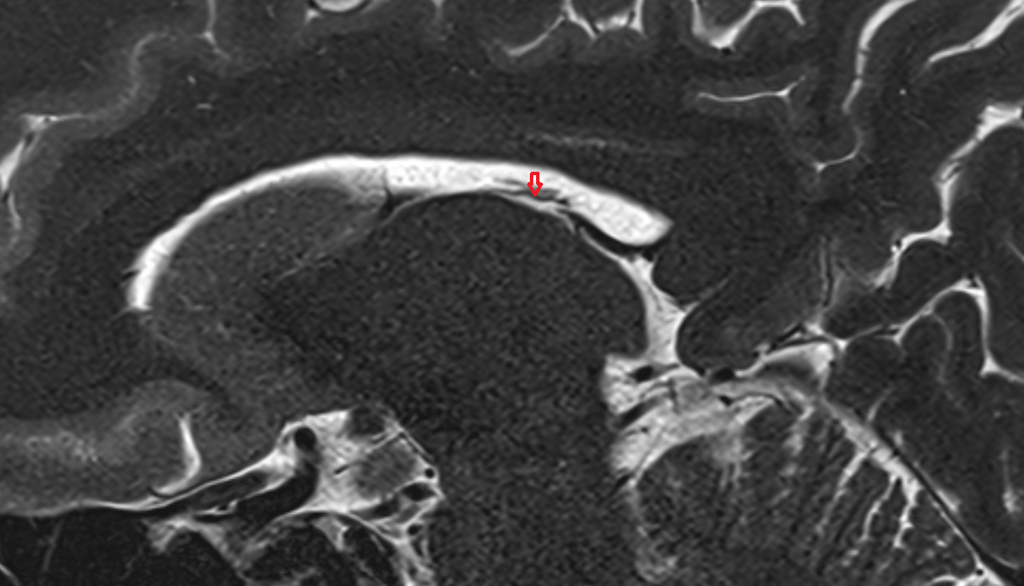 MRI Tenia of fornix anatomy image -img-00000-00000_00001