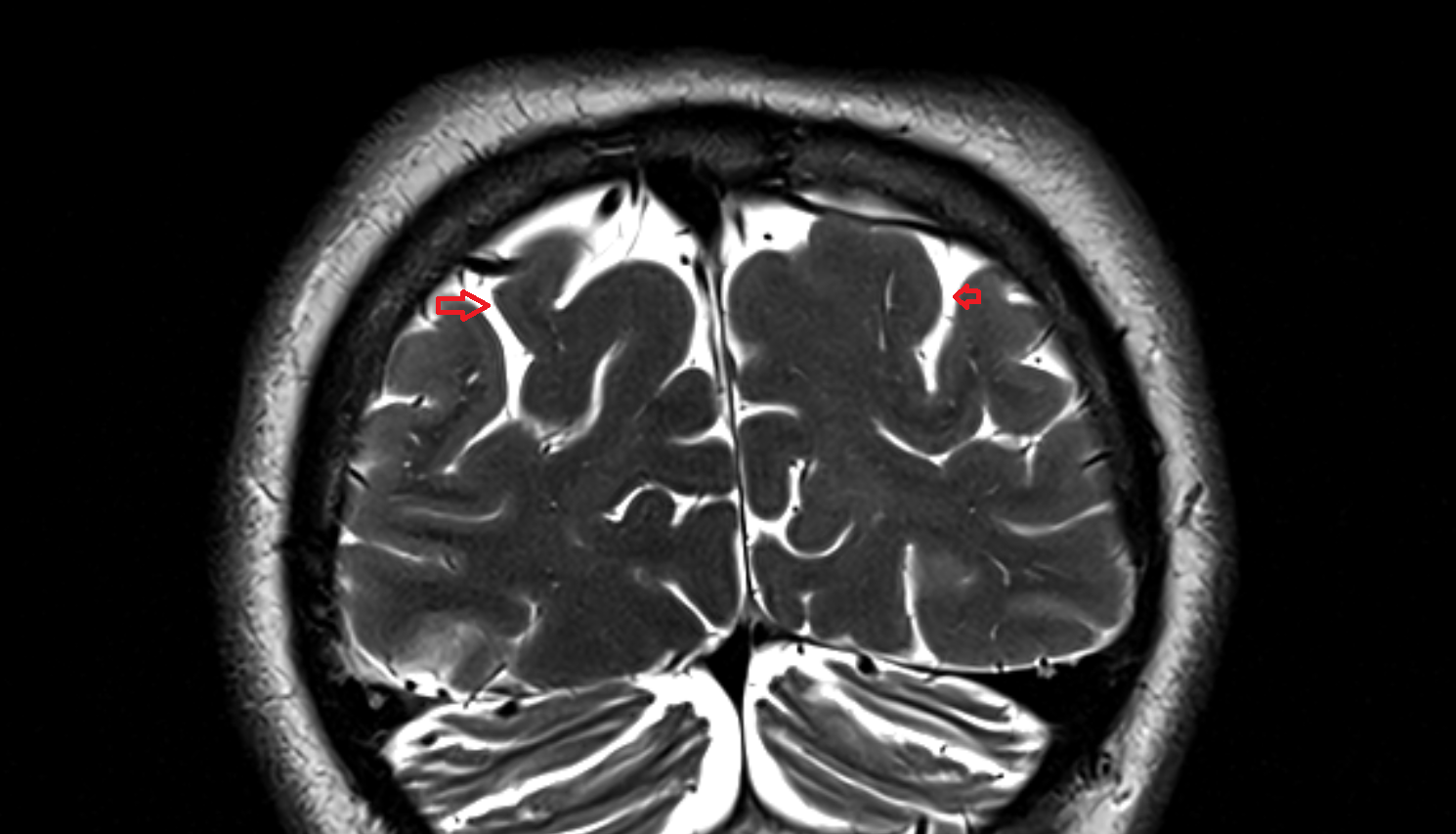 MRI Transverse occipital sulcus coronal anatomy image -img-00000-00000