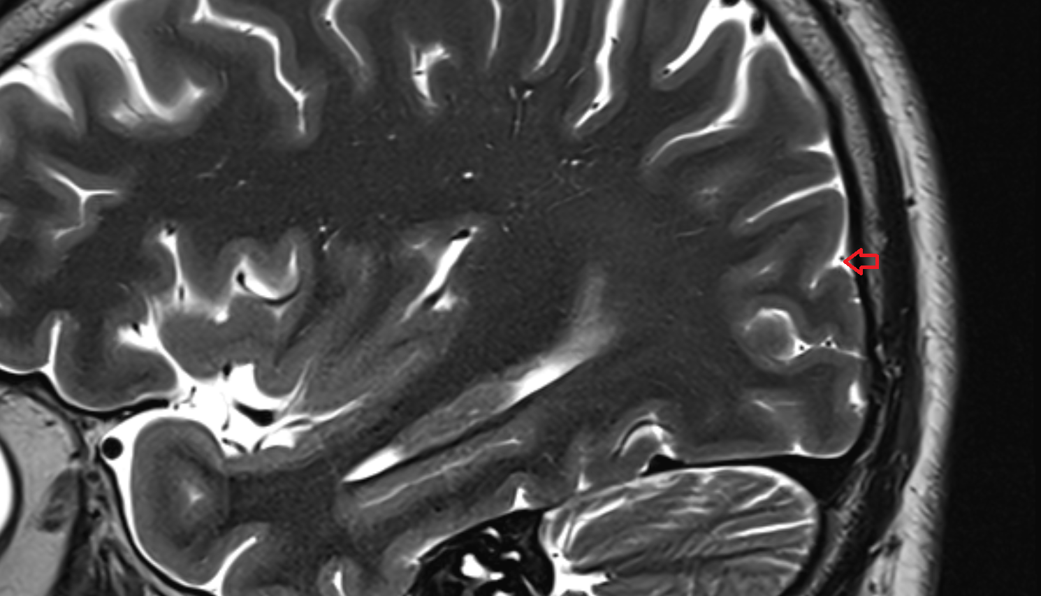 MRI Transverse occipital sulcus sag anatomy image -img-00000-00000