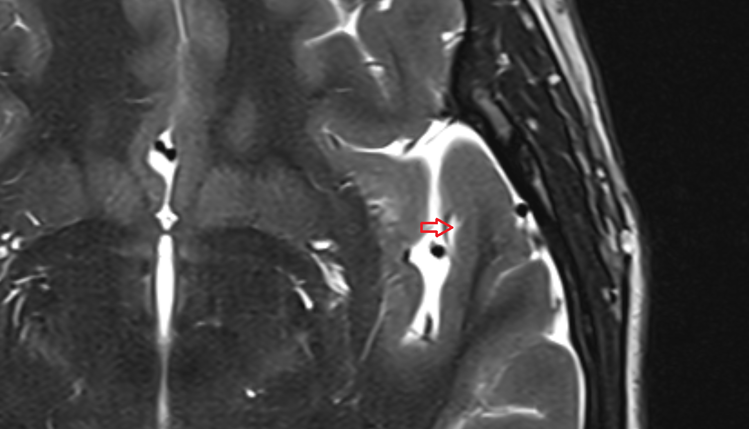 MRI Transverse temporal sulcus axial anatomy image -img-00000-00000