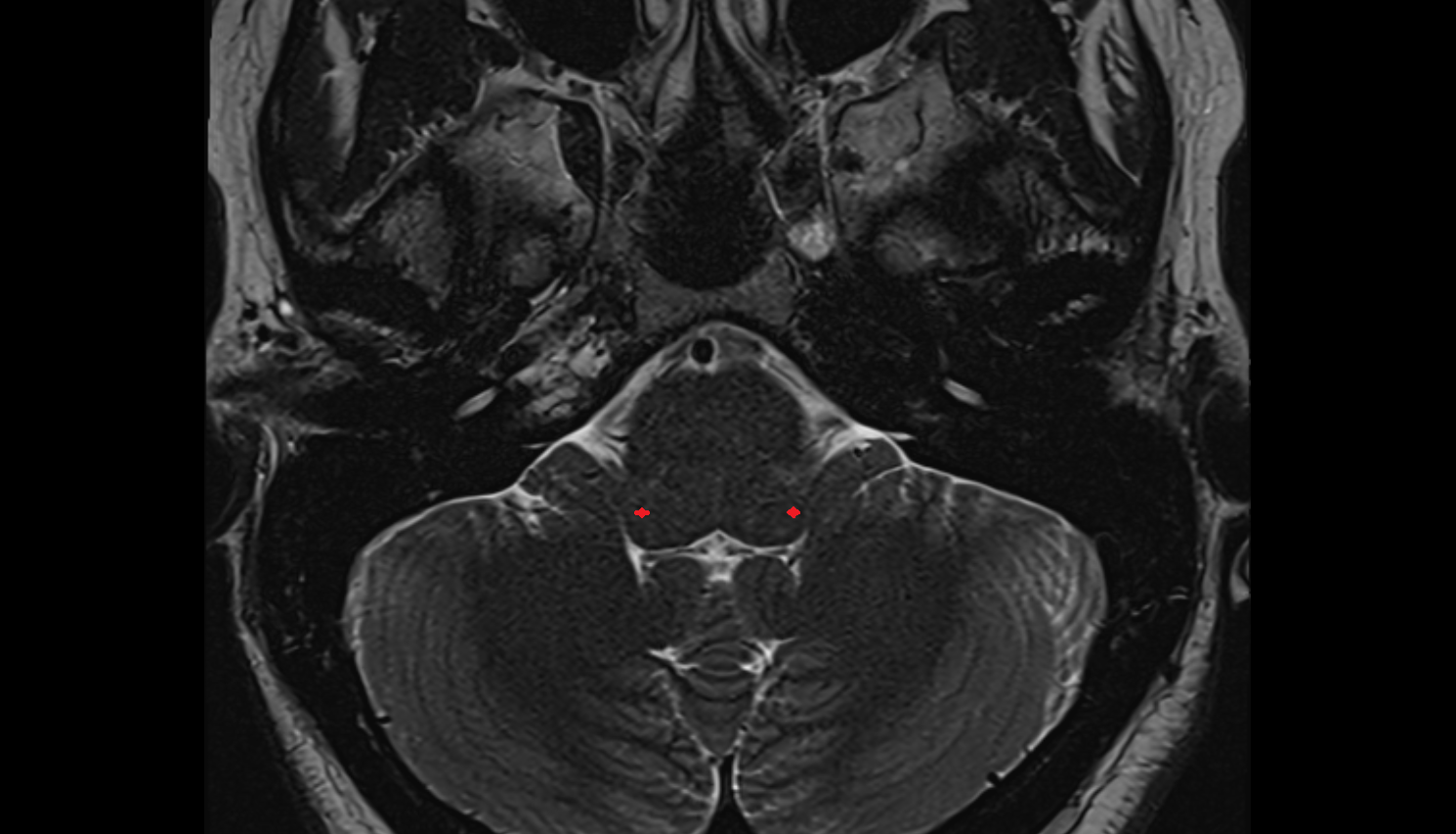 MRI Ventral cochlear nucleus  axial anatomy image -img-00000-00000