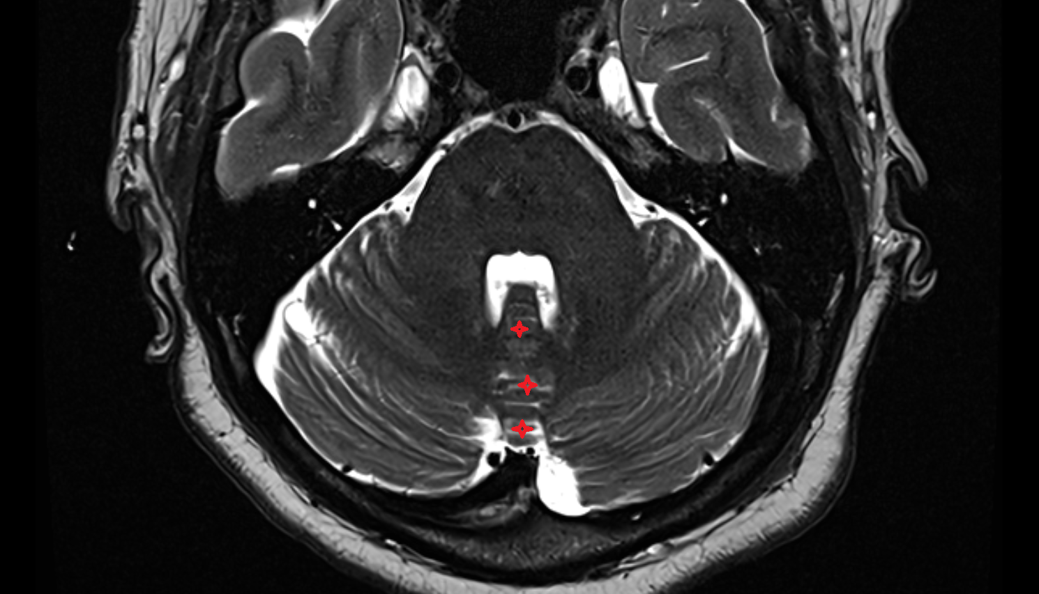 MRI  Vermis of cerebellum axial anatomy image -img-00000-00000