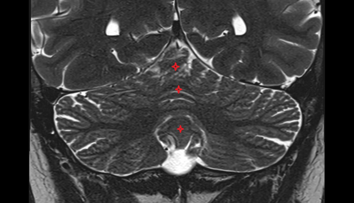 MRI Vermis of cerebellum coronal anatomy image -img-00000-00000