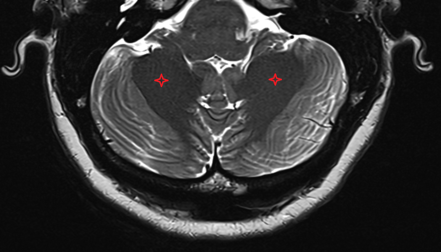 MRI White substance of cerebellum axial anatomy image -img-00000-00000