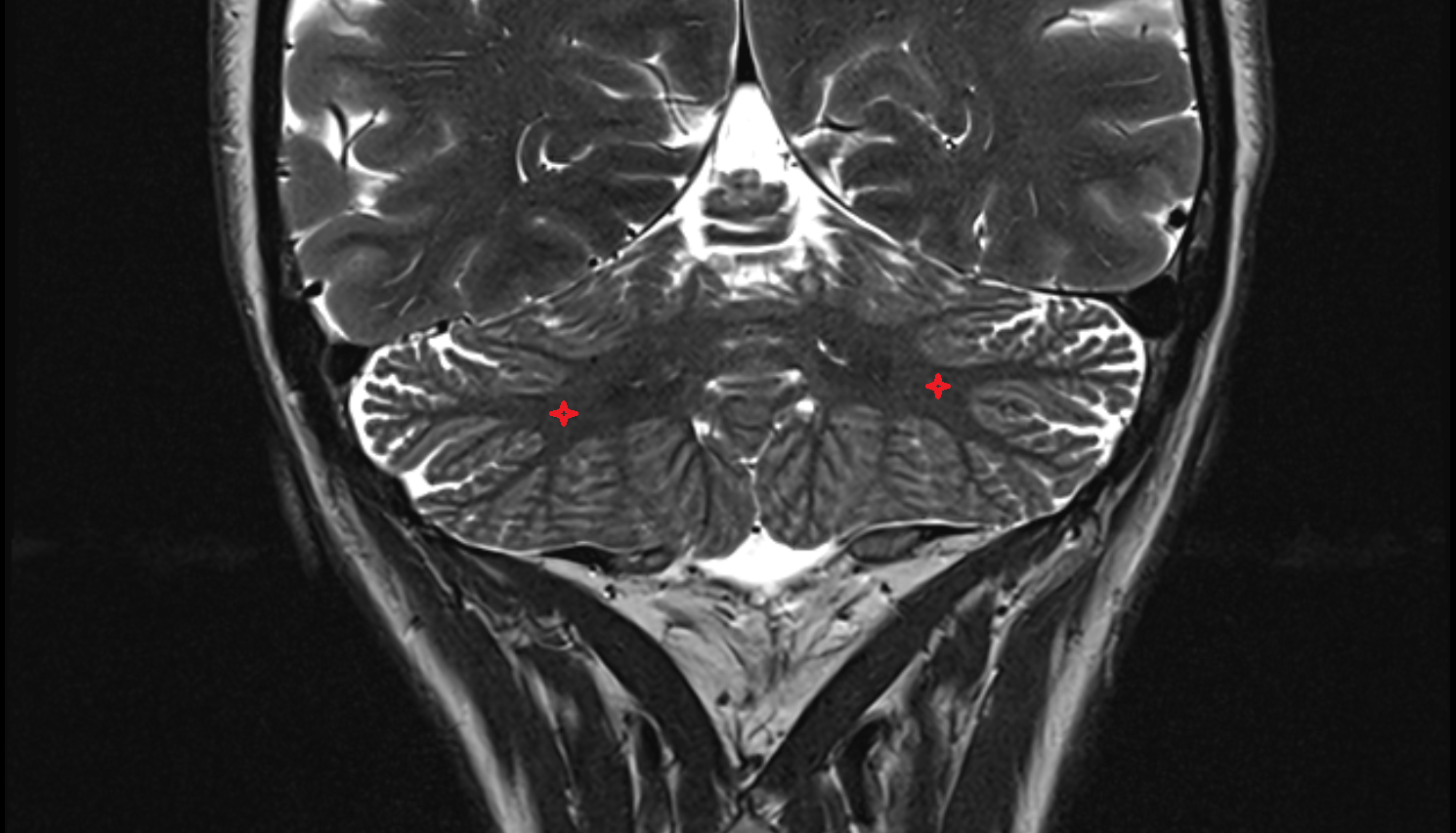 MRI White substance of cerebellum coronal anatomy image -img-00000-00000