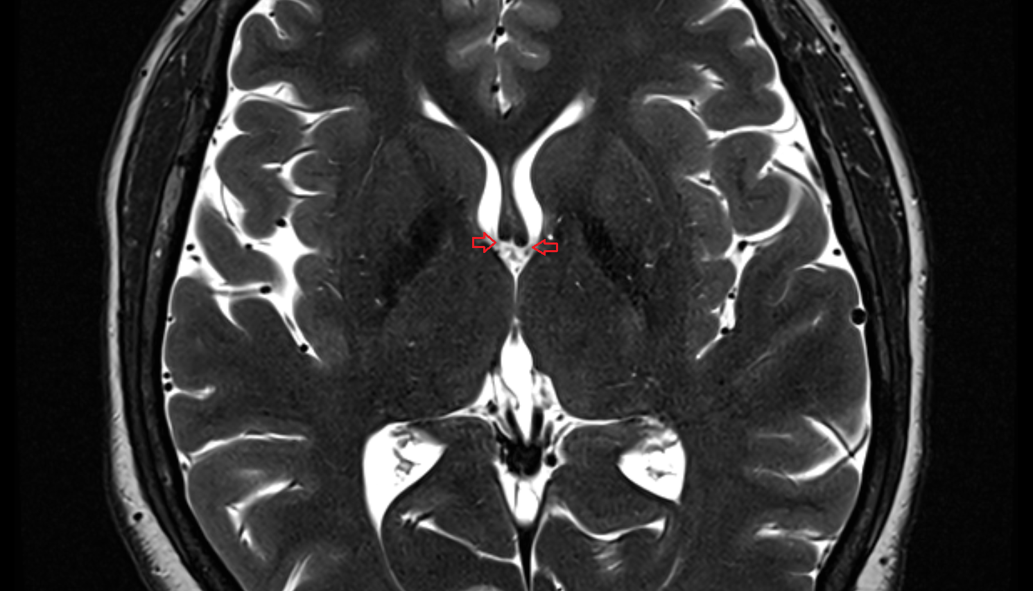 MRI foramen of Monro axial anatomy image -img-00000-00000