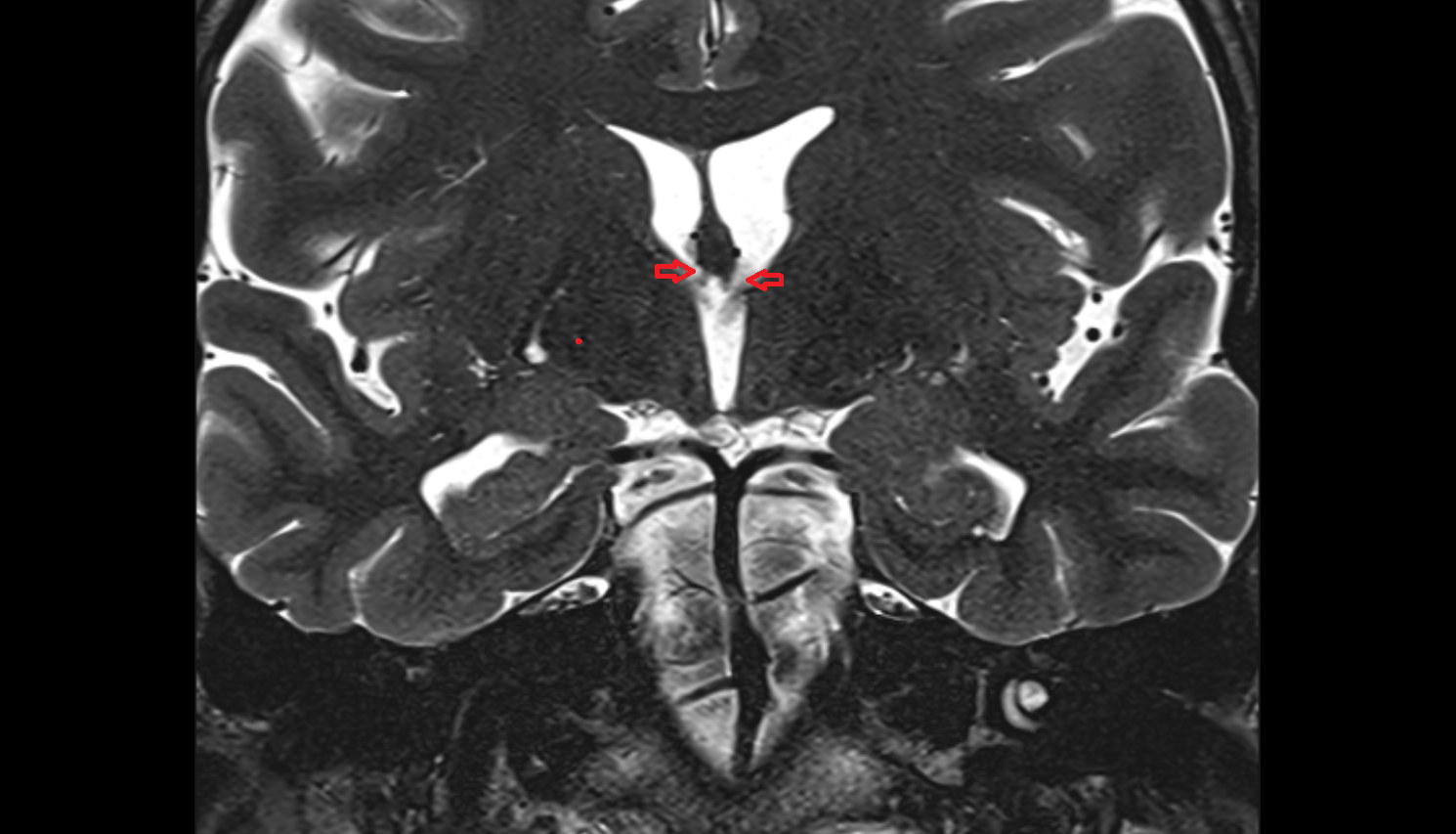 MRI foramen of Monro coronal anatomy image -img-00000-00000