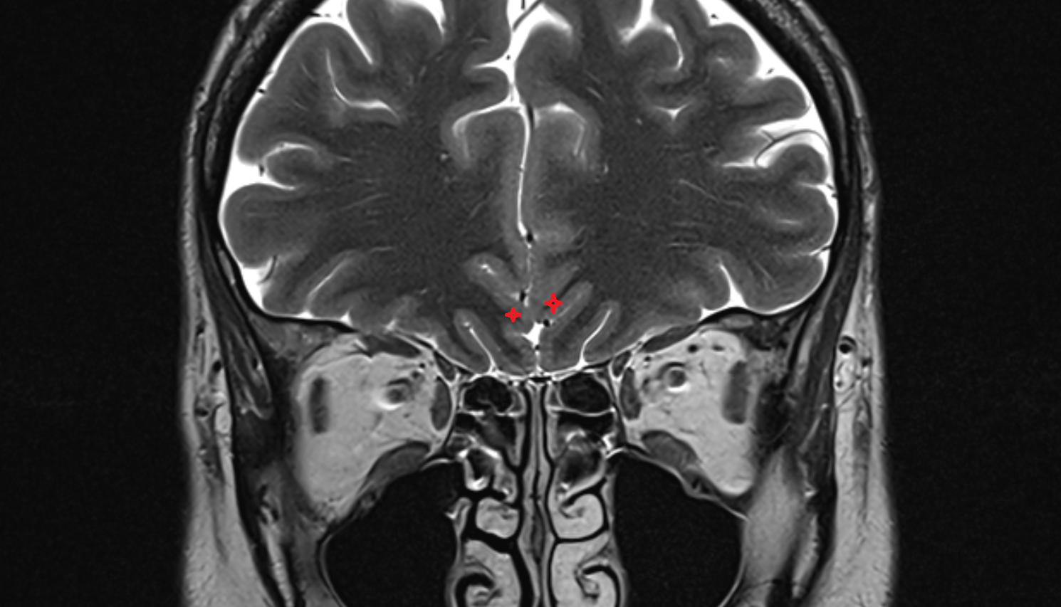 MRI rostral gyrus coronal anatomy image -img-00000-00000