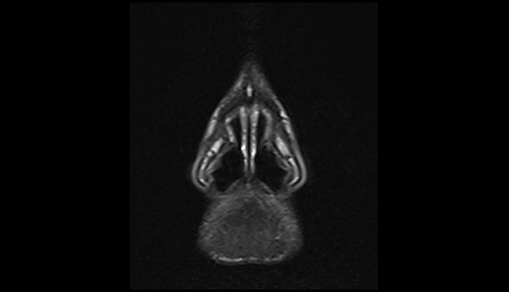 Major alar cartilage MRI