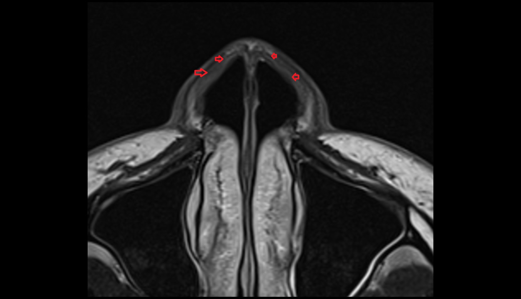 Major alar cartilage MRI AXIAL