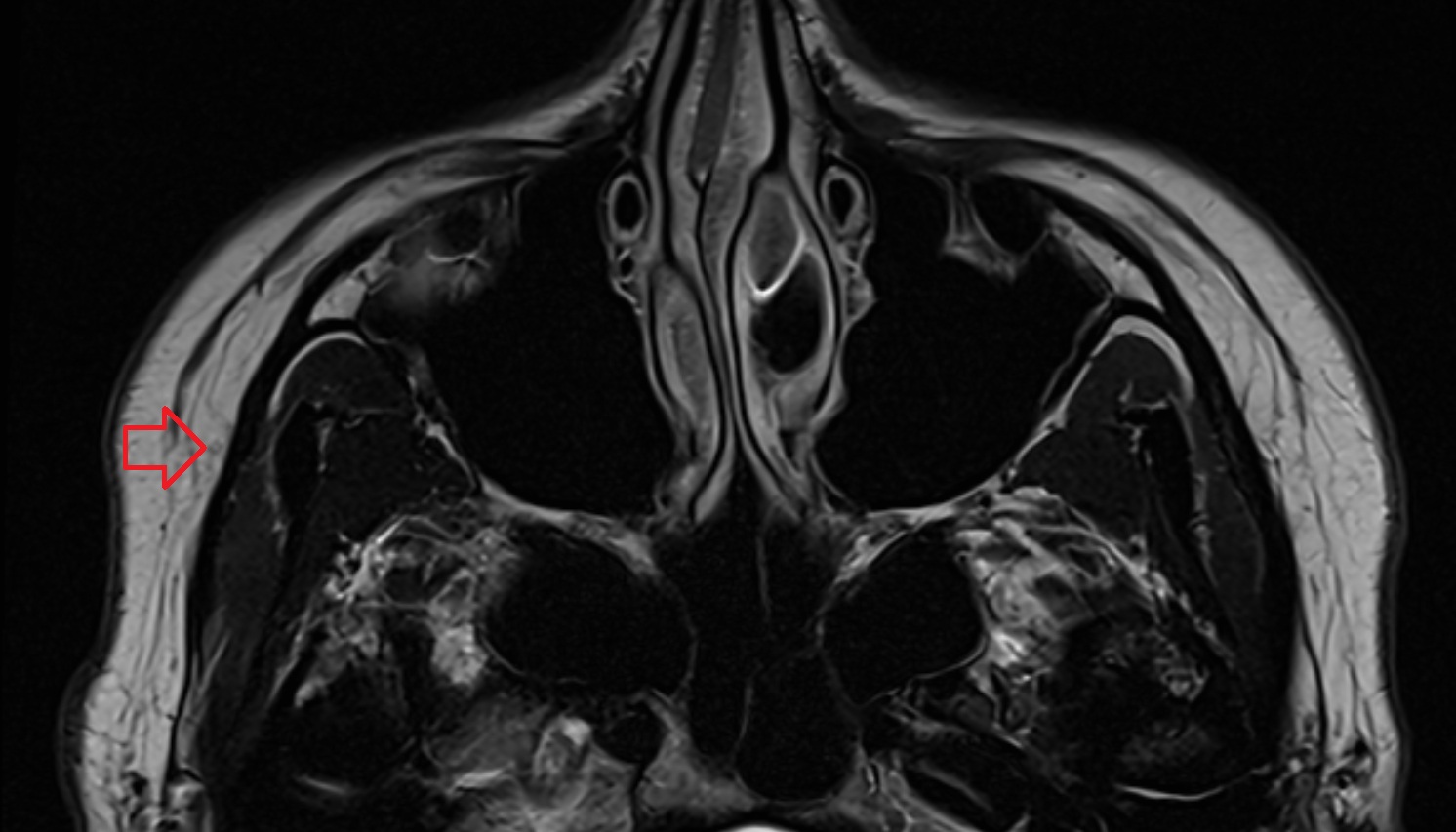 Malar (Zygomatic) Lymph Nodes mri axial  image -img-00000-00000