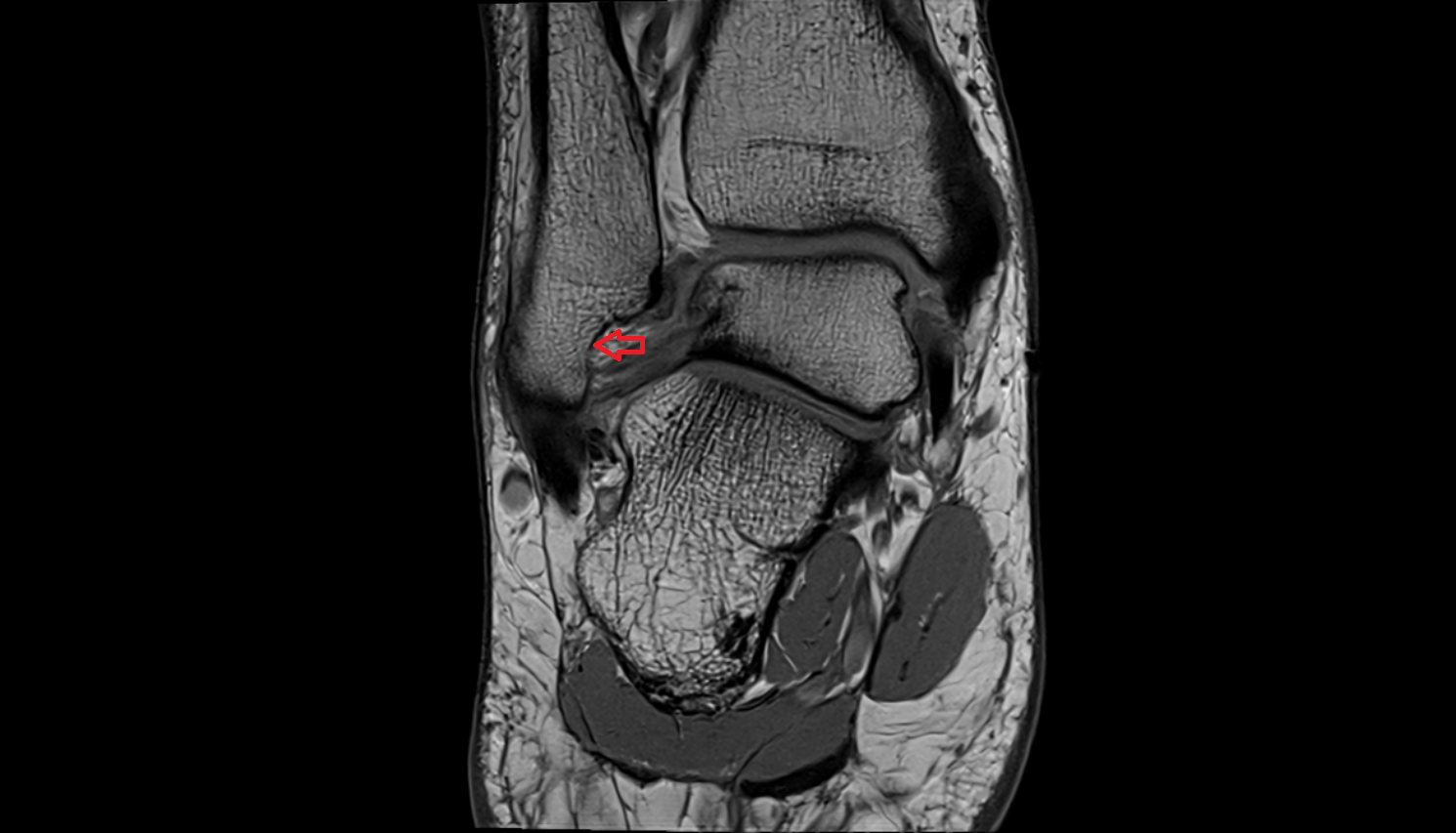 Malleolar fossa  mri  anatomy labelled image-img-00000-00000