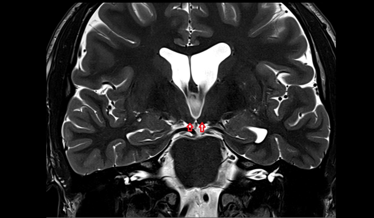 Mammillary body mri 3t coronal image