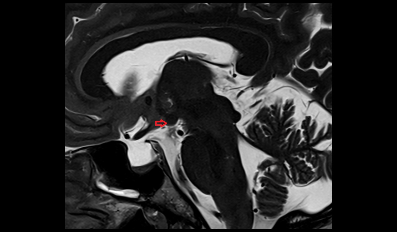 Mammillary body mri 3t sagittal image