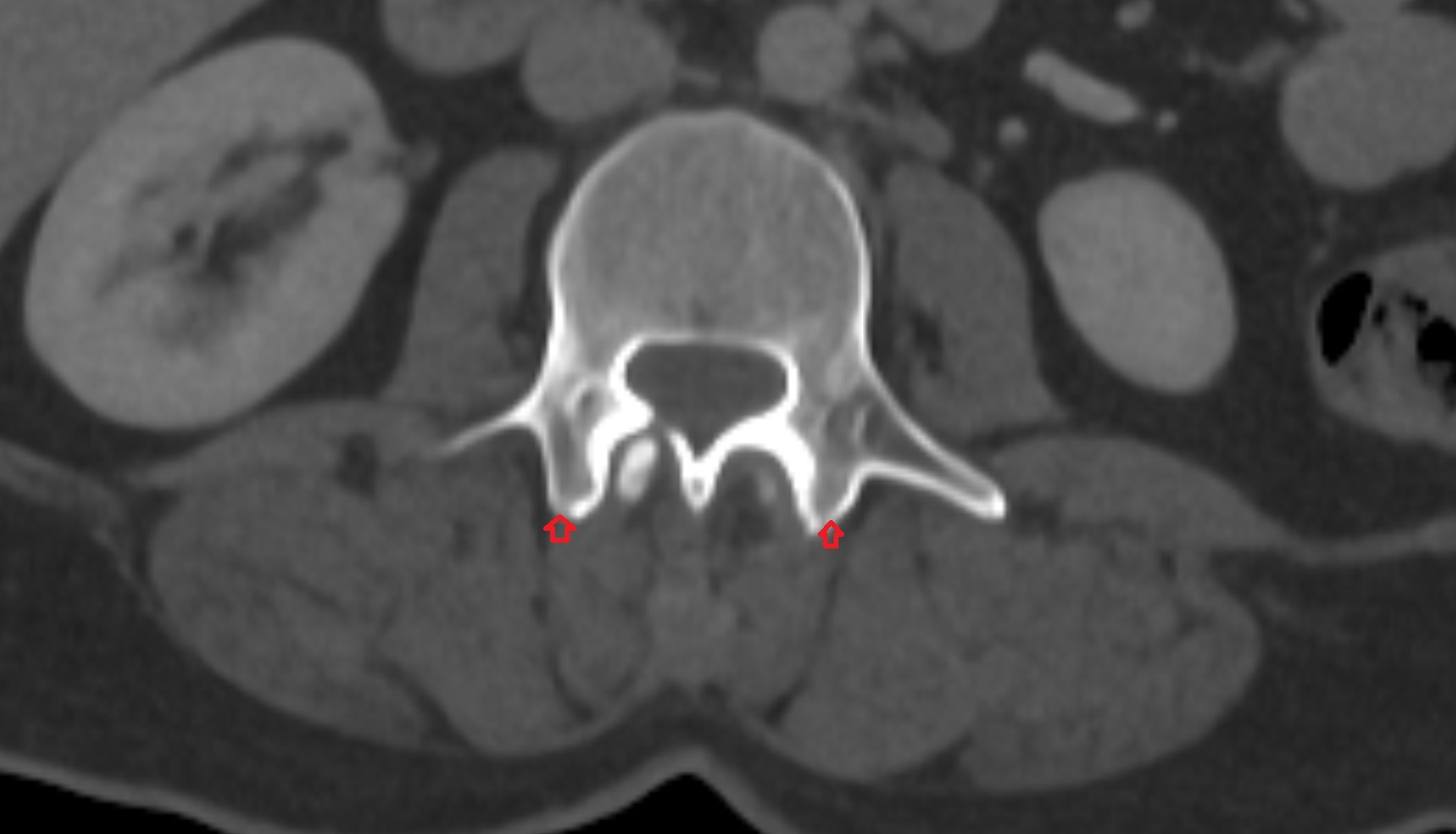 Mammillary process of  vertebra CT AXIAL   anatomy  image-img-00000-00000