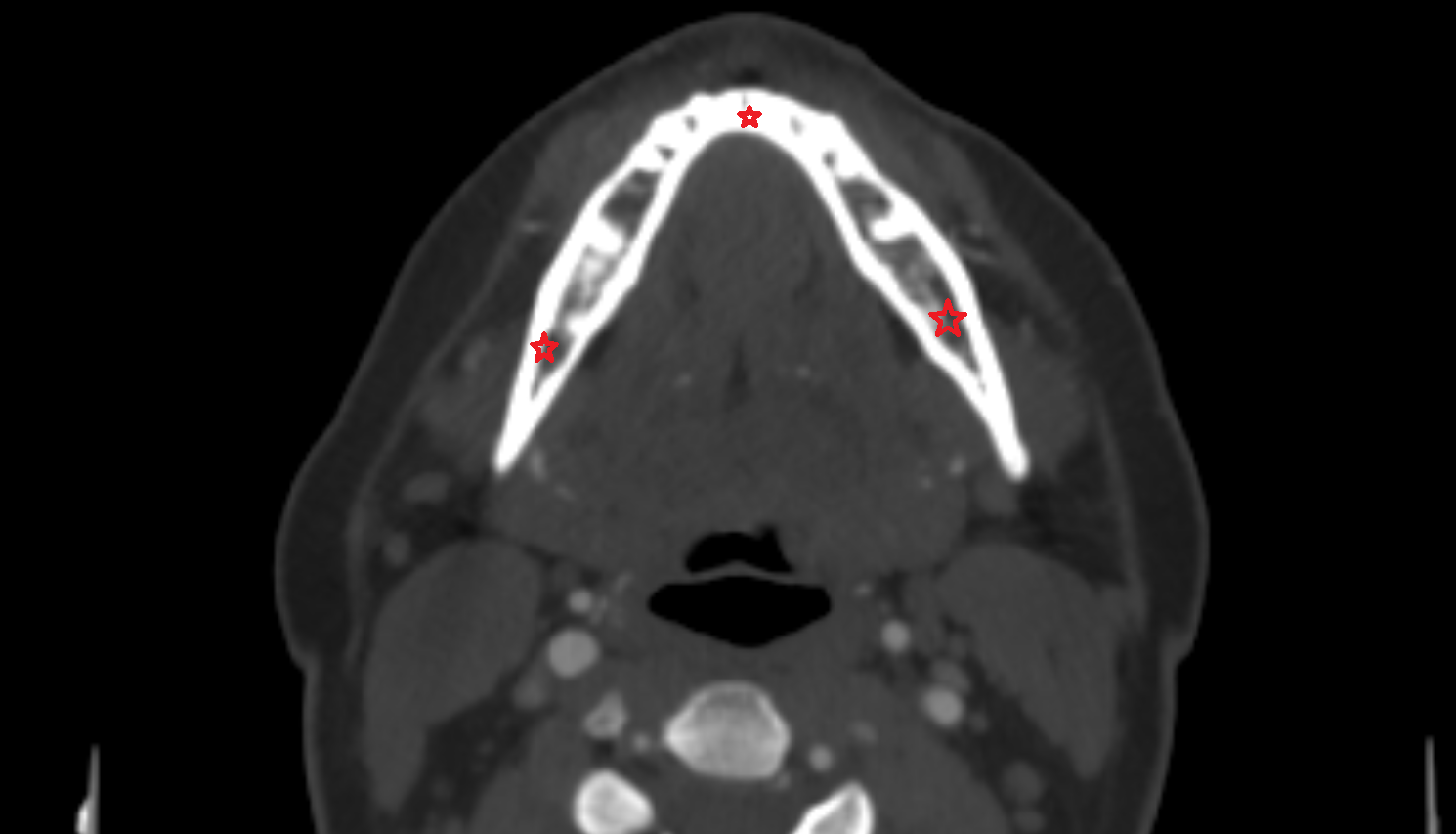 Mandible CT axial Anatomy, Location and Imaging Appearance  -img-00000-00000