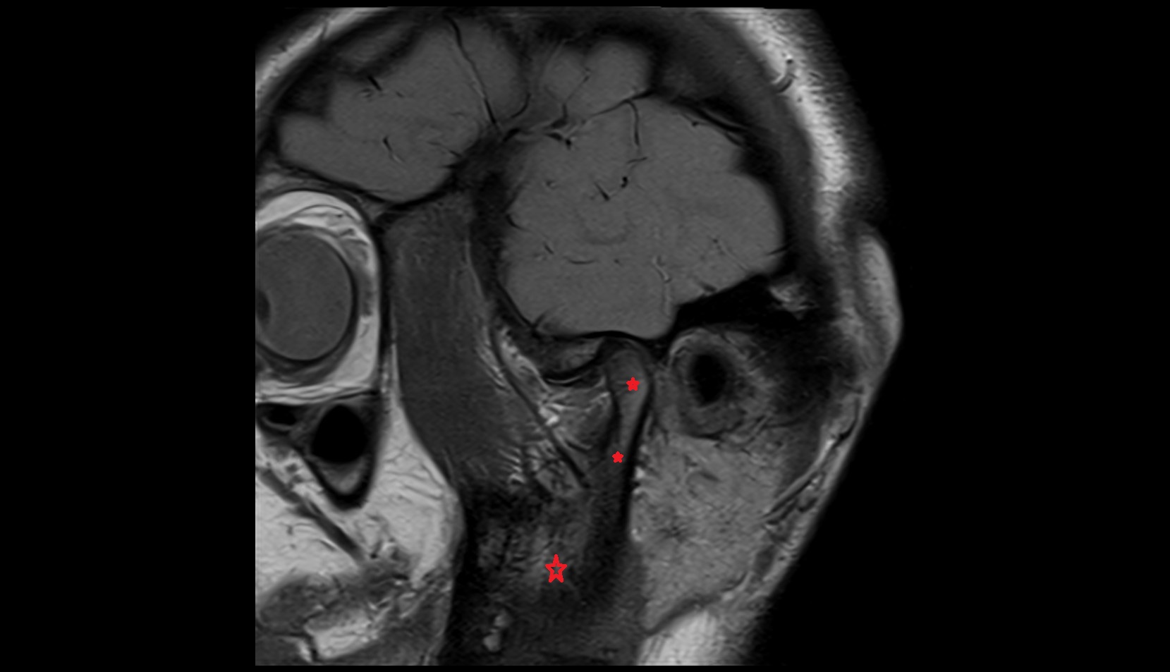 Mandible mri