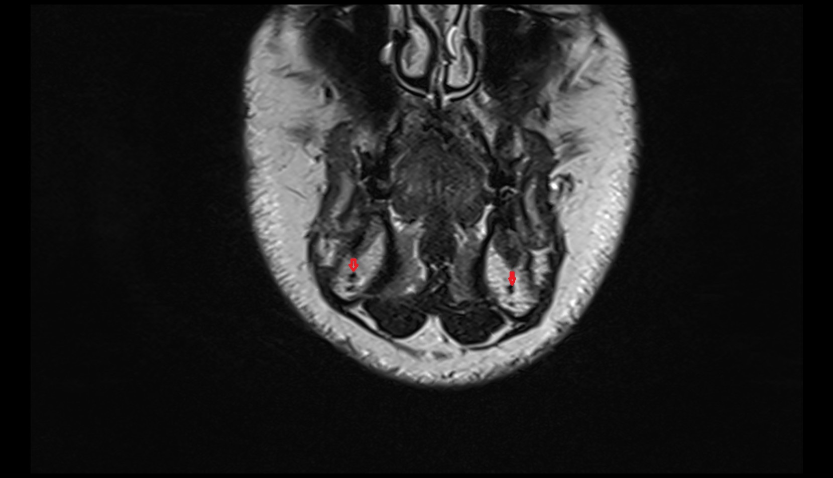 Mandibular canal  coronal