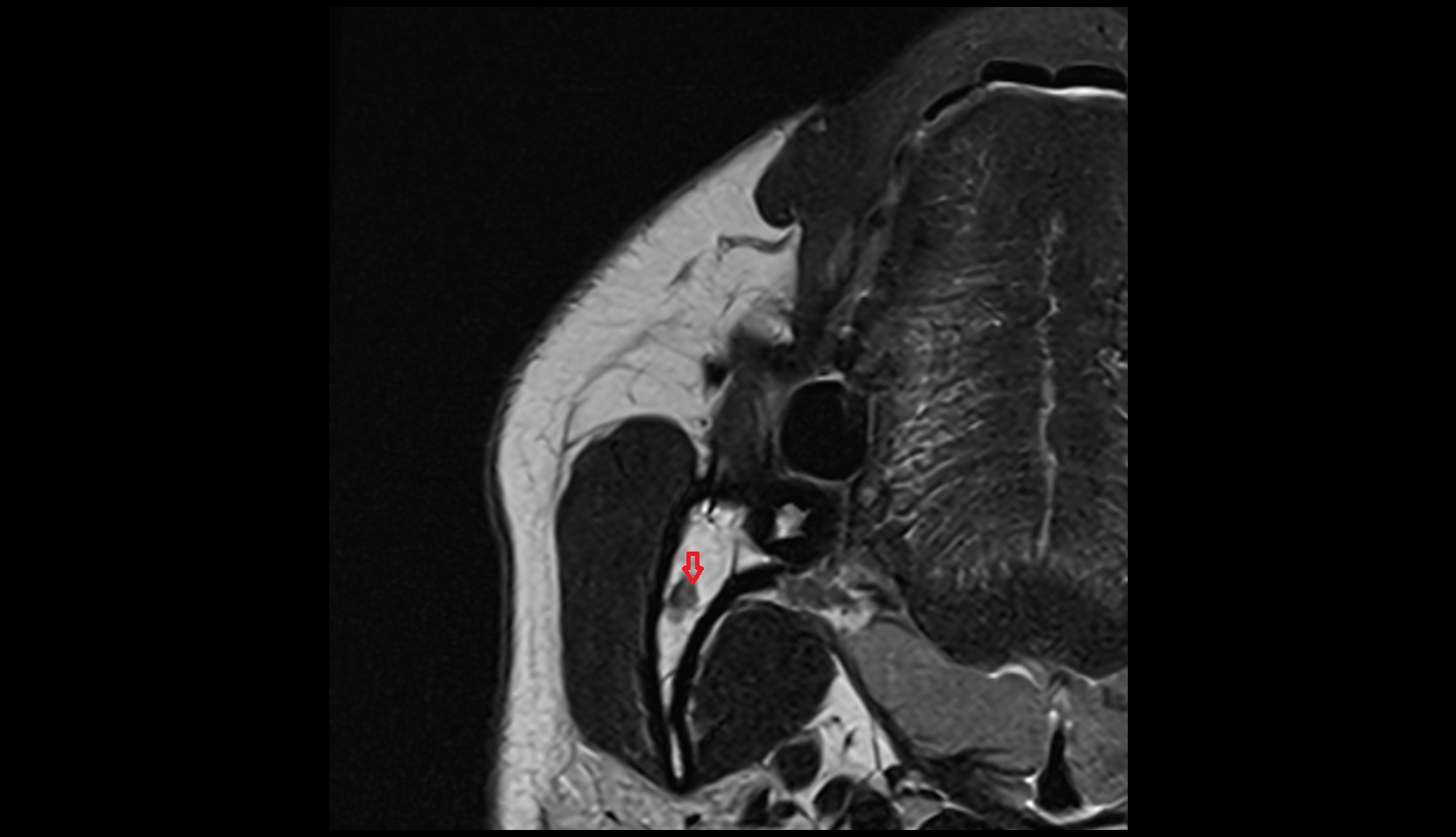 Mandibular canal mri axial image