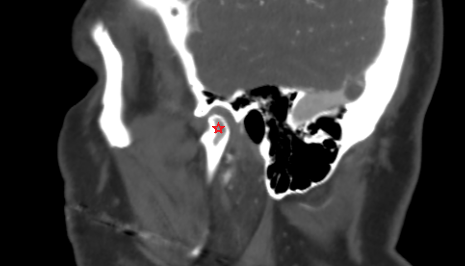 Mandibular condyle CT  anatomy image -img-00000-00000