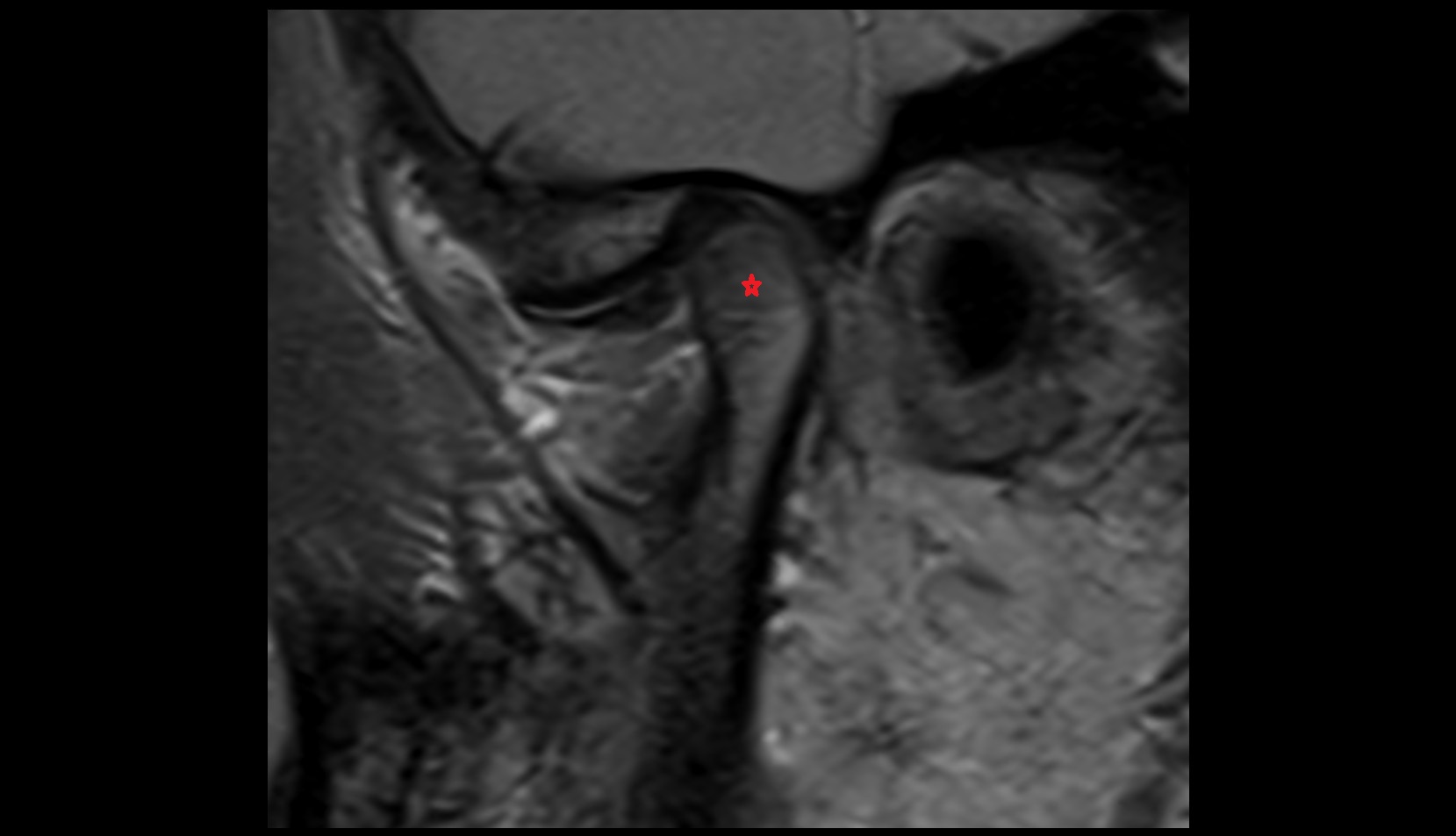 Mandibular condyle mri
