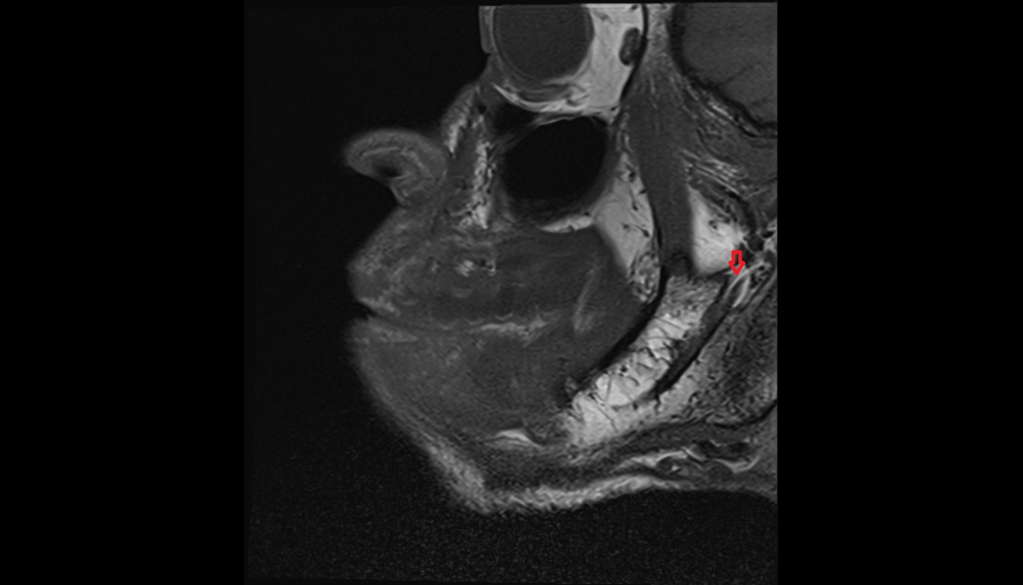 Mandibular foramen  mri sagittal  image -img-00000-00000