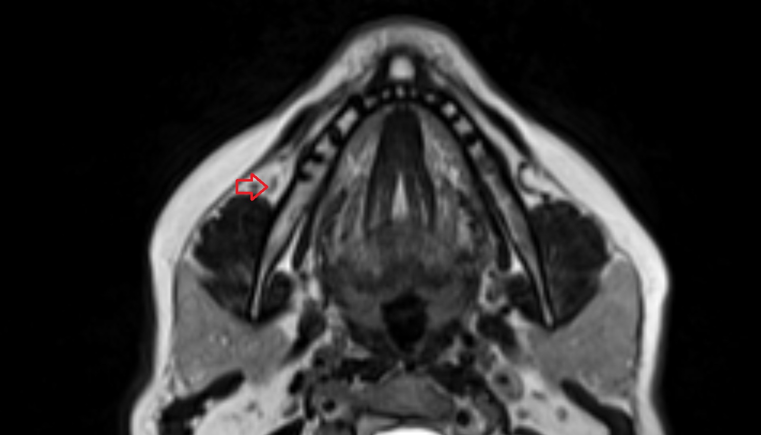 Mandibular lymph nodes mri axial  image -img-00000-00000