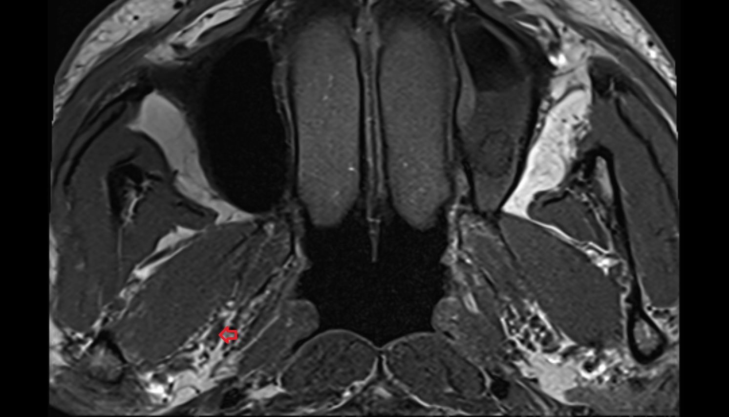 Mandibular nerve  mri AXIAL  image -img-00000-00000