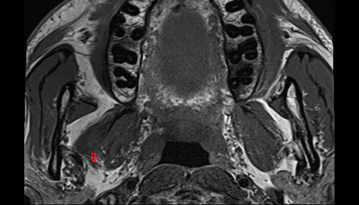 Mandibular nerve  mri AXIAL  image -img-00000-00000_00001