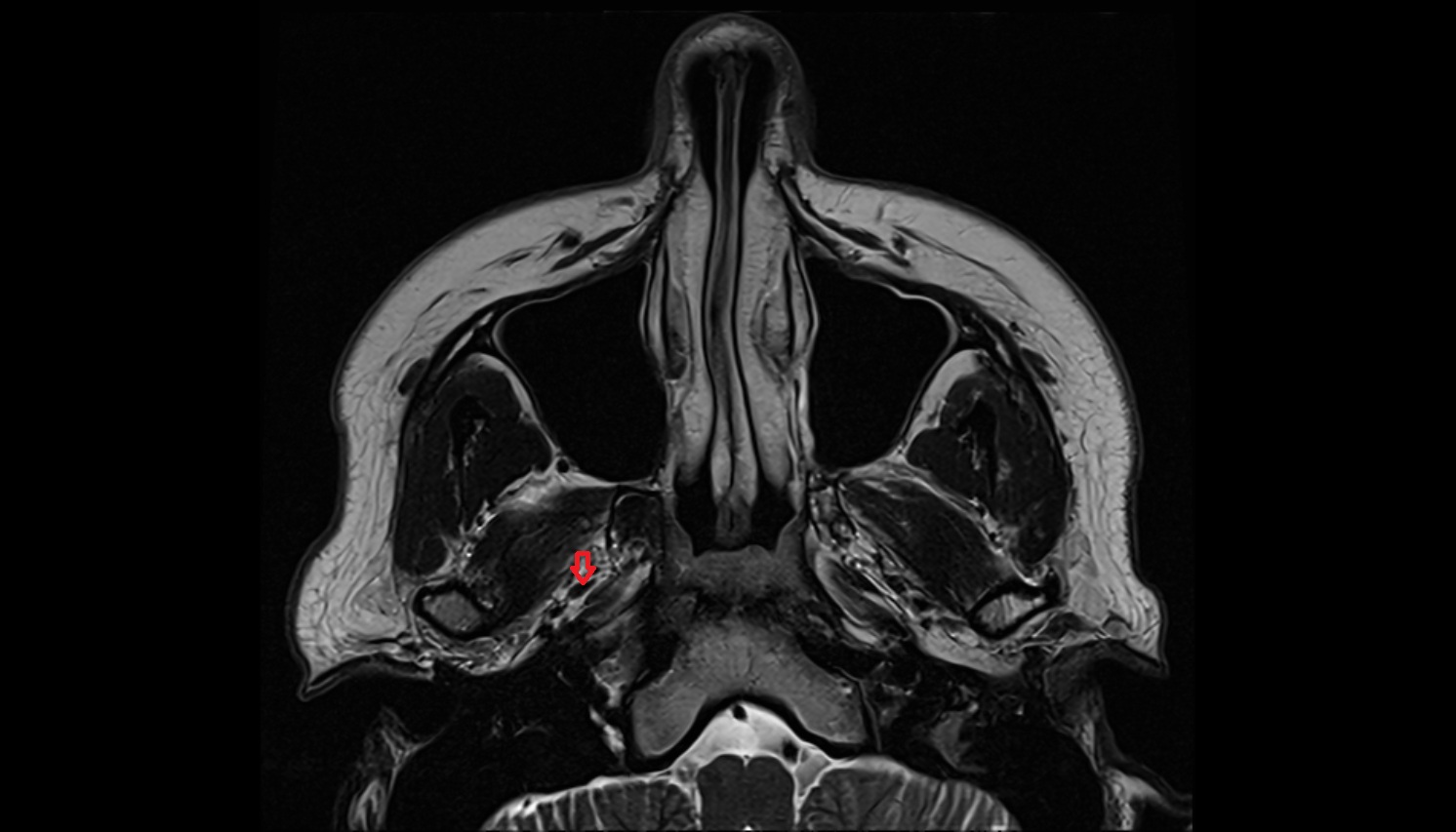 Mandibular nerve  mri AXIAL  image -img-00000-00000_00002