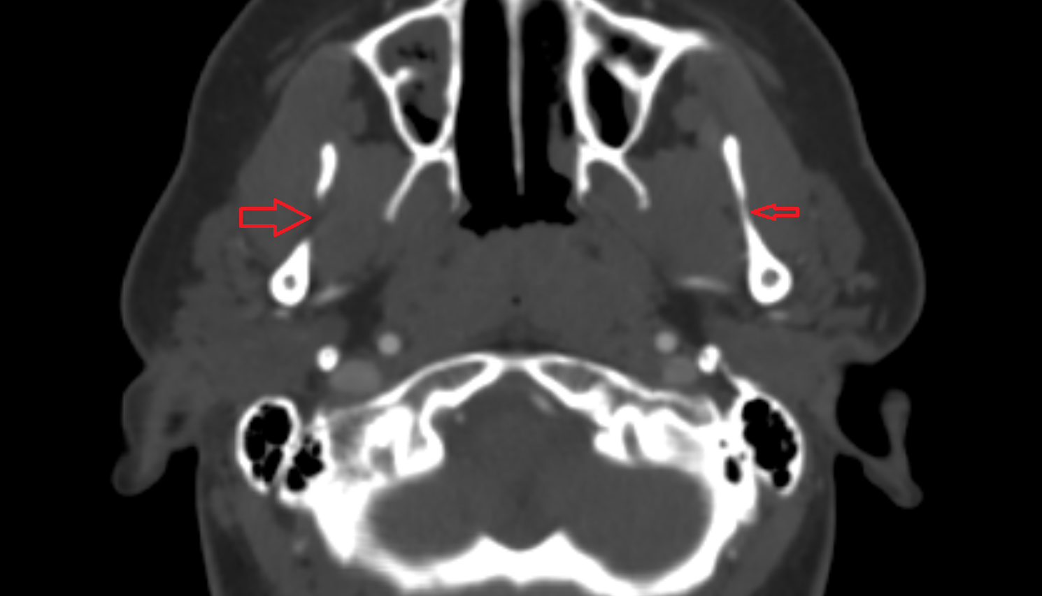 Mandibular notch  CT anatomy labelled image-img-00000-00000